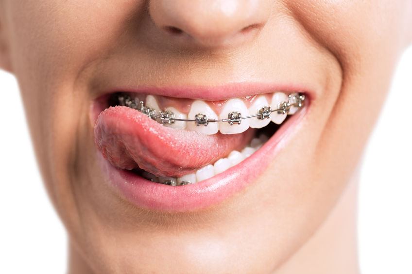 Quali tipi di apparecchio si usano per allineare i denti?