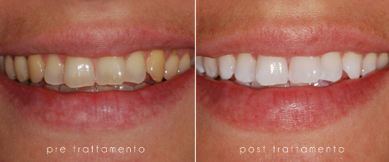 Pre e Post Trattamento per sbiancamento dentale